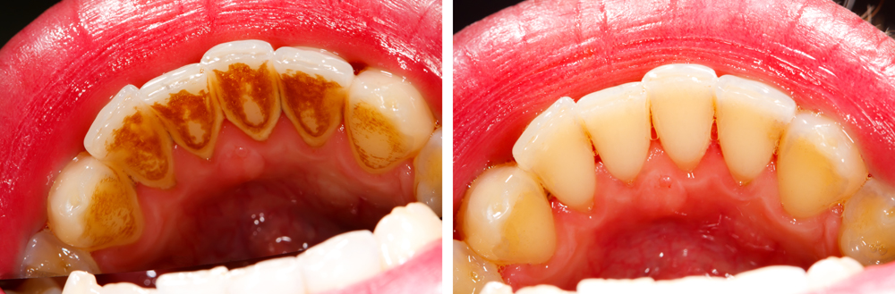 dentalsscaling 8.jpg