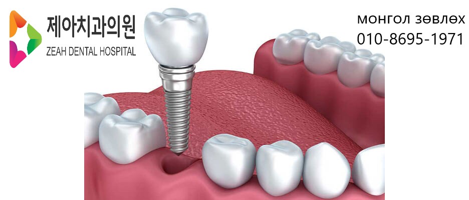 single-implant-graphic-photo.jpg