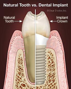 natural-tooth.jpg