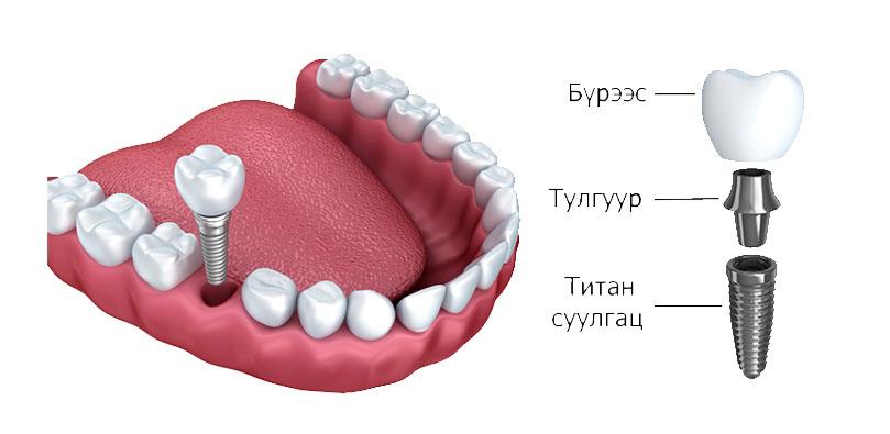 Implant11.jpg