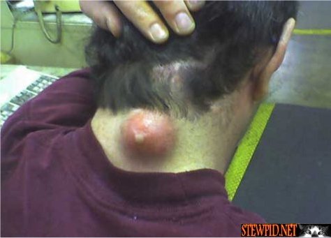 monster-zit.jpg