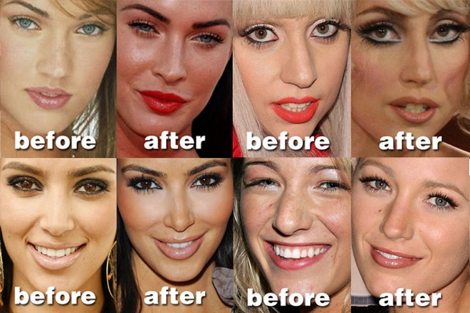 Nose-Job-Before-After-Image.jpg