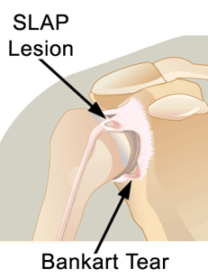 slap-lesion-bankart-tear.gif