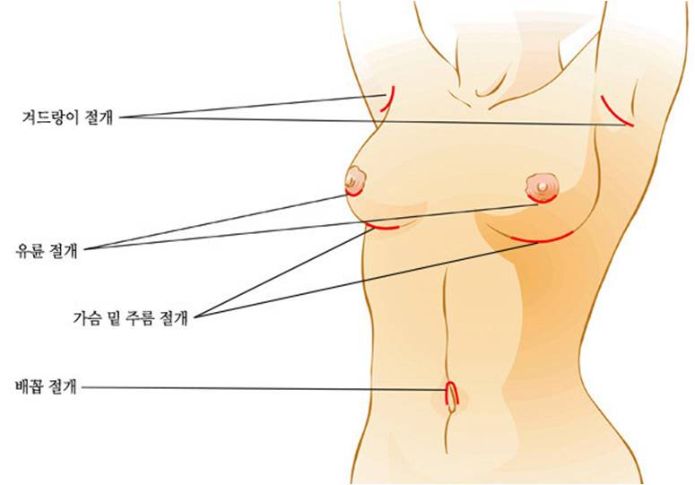 가슴확대수술 종류.jpg